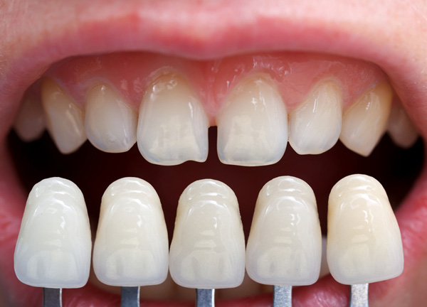 Porcelain Dental Veneers Los Angeles